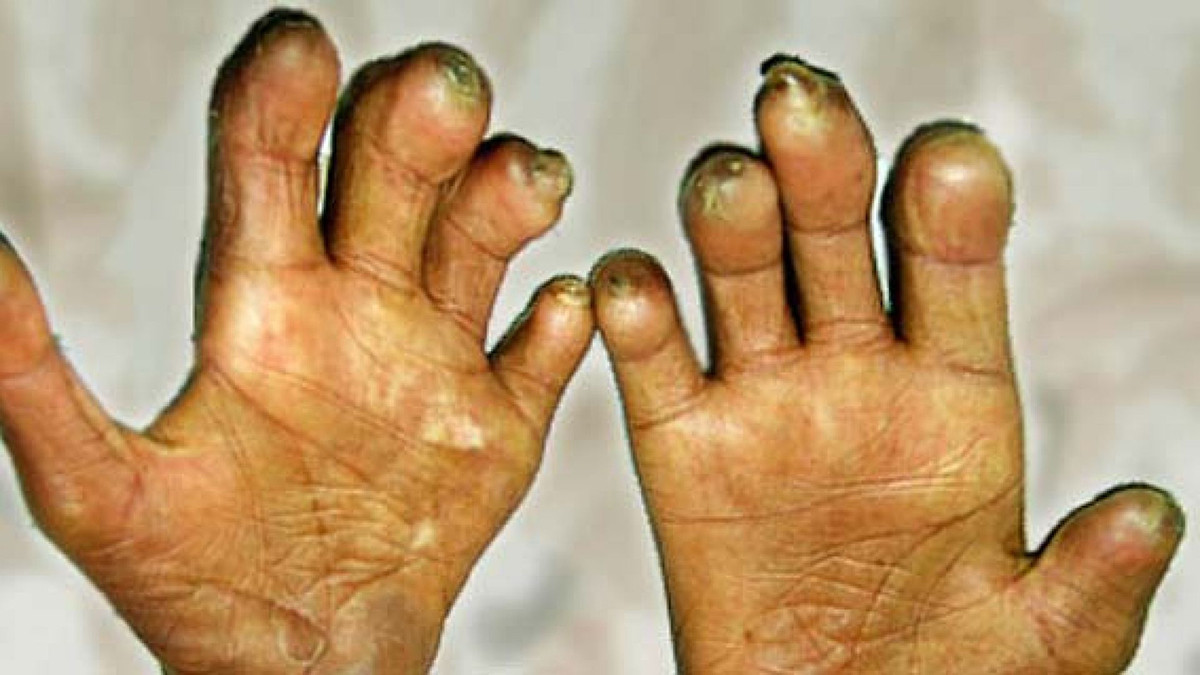 नेपालमा हरेक वर्ष झन्डै तीन हजार जना कुष्ठरोगका नयाँ बिरामी